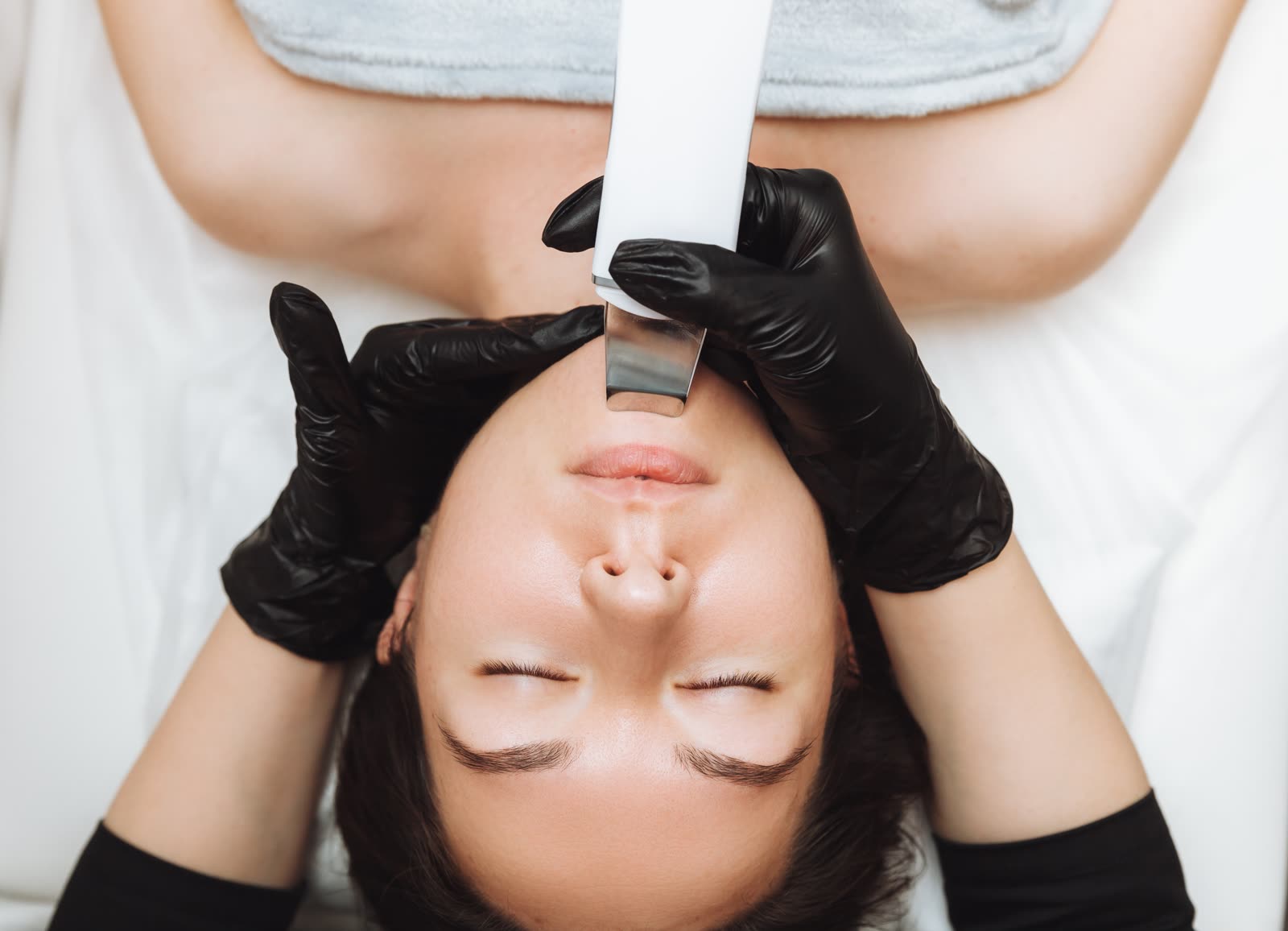 Chemical Peel