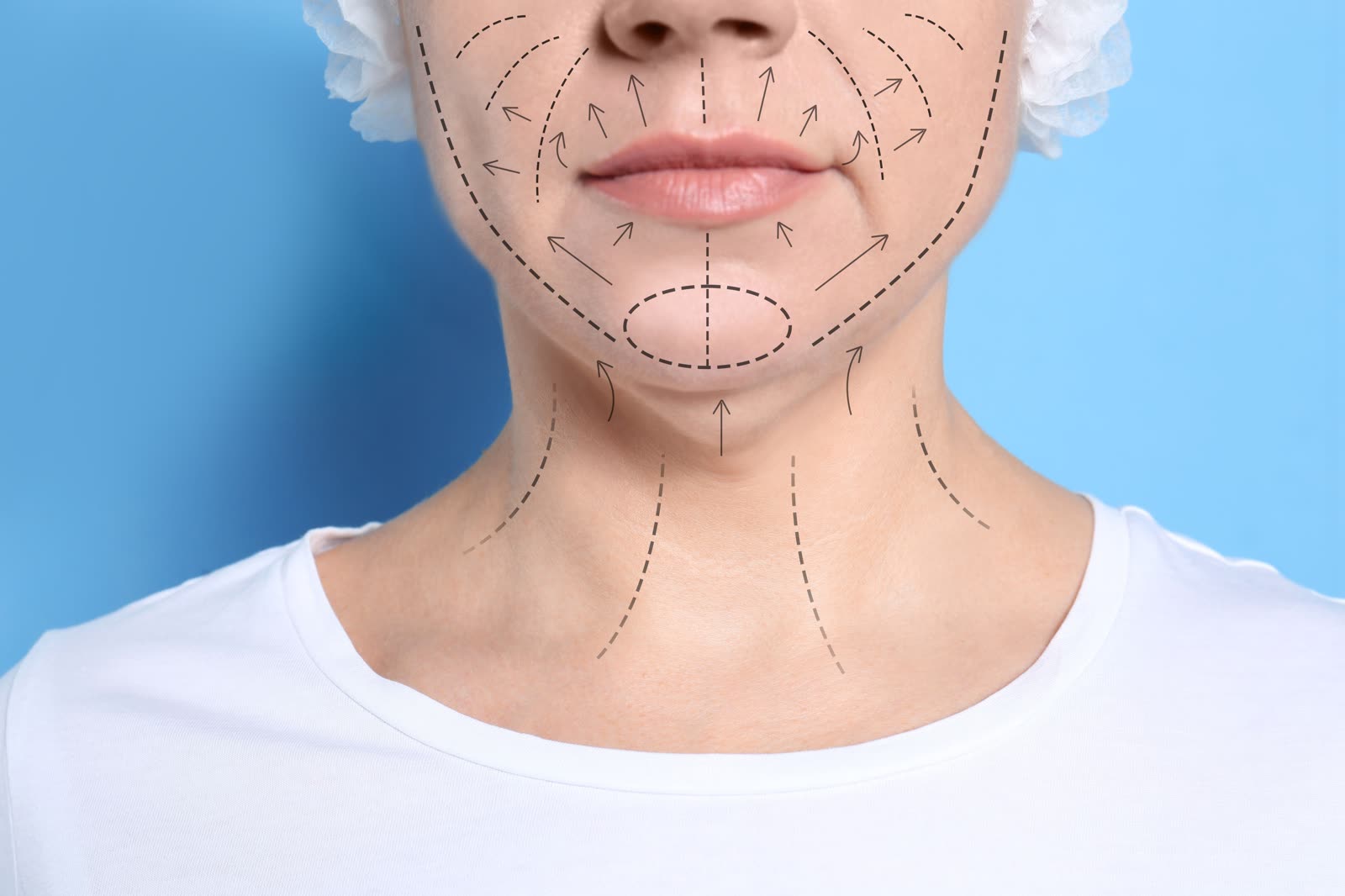 Double Chin Reduction