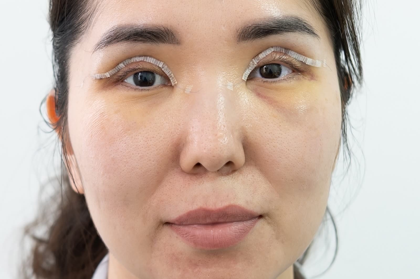 Epicanthoplasty