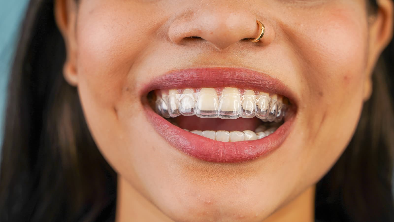 Invisalign