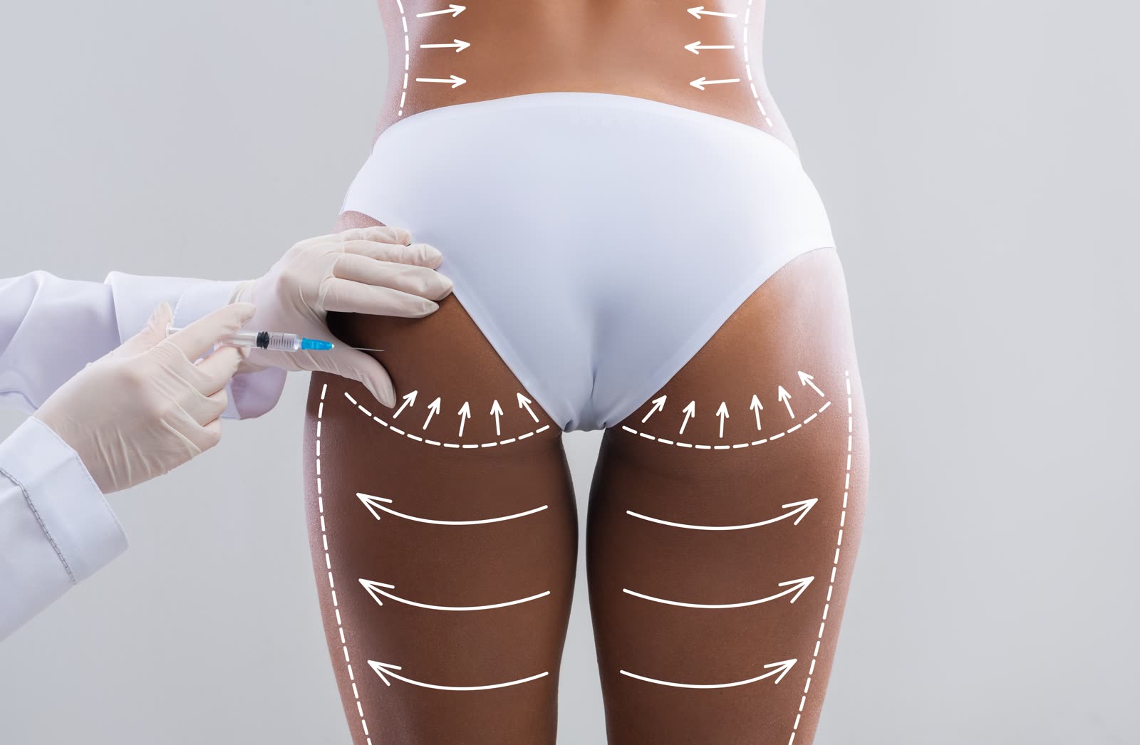 Buttock Augmentation (svf)