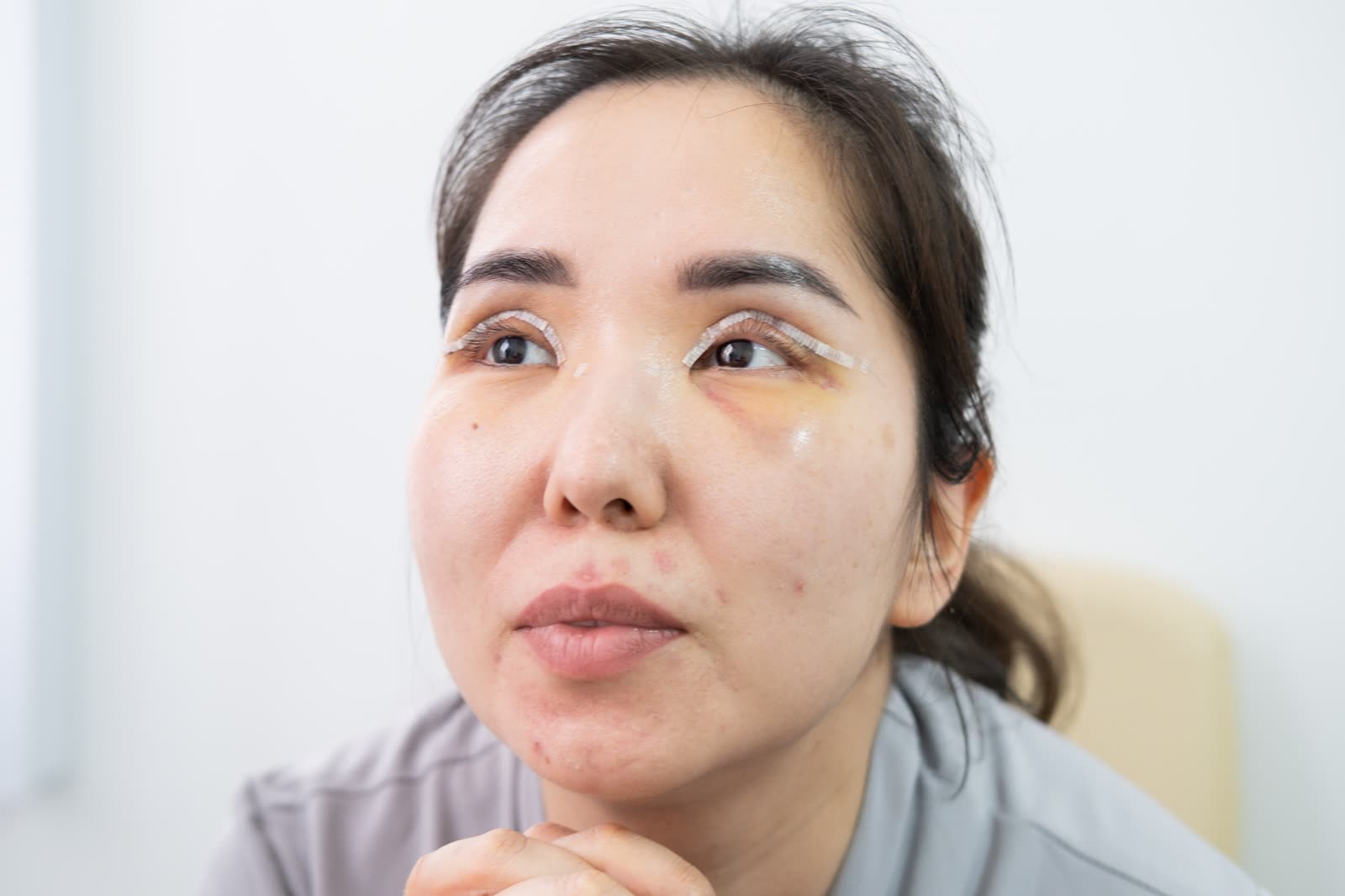 Double-eyelid Surgery