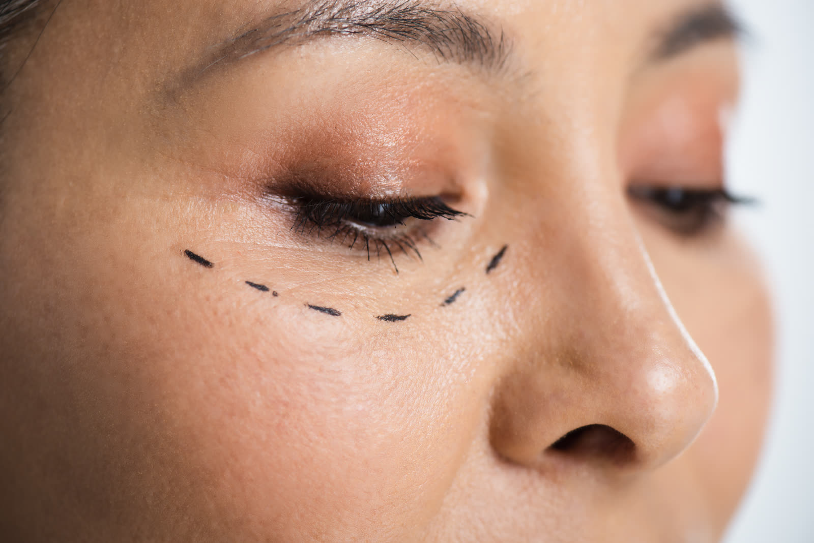 Chin Surgery